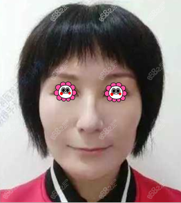 花4万多做的微创悬吊术除皱术后效果不错