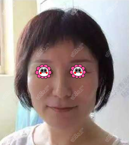 我做微创悬吊术除皱前