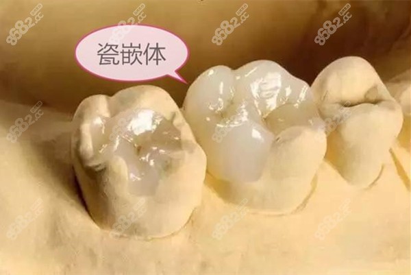 瓷嵌体在牙模上的展示图