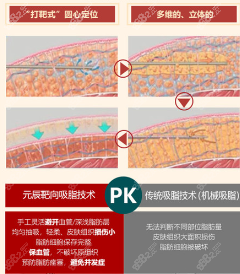 沈阳元辰整形医院吸脂的优势