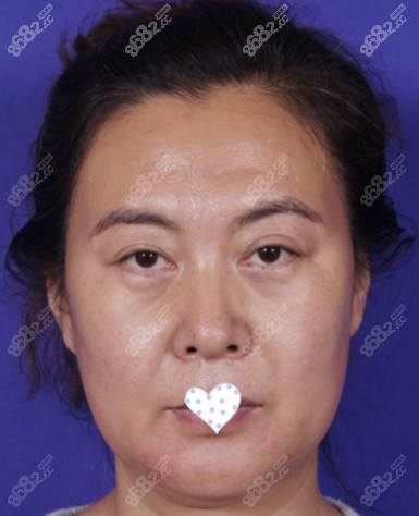 术前照片