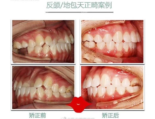 重慶團(tuán)圓口腔牙齒矯正前后對比圖分享