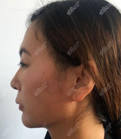 脸部拉皮手术疤痕图片
