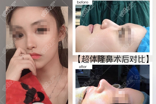 福州格莱美美容医院超体隆鼻术前术后对比图