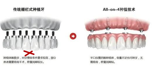 传统种植牙和all-on-4种植牙