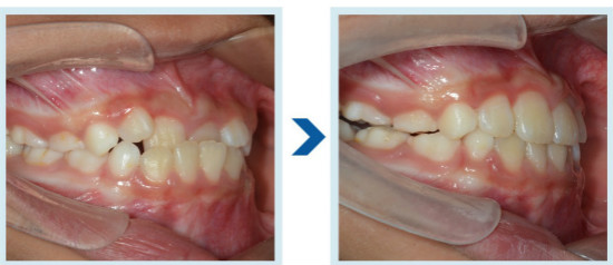 南宁柏乐口腔做牙齿矫正好不?牙友门牙矫正19个月效果明显