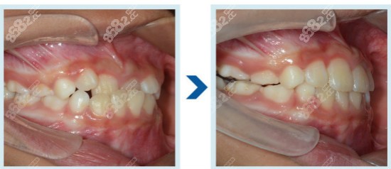 南宁柏乐口腔牙齿矫正效果
