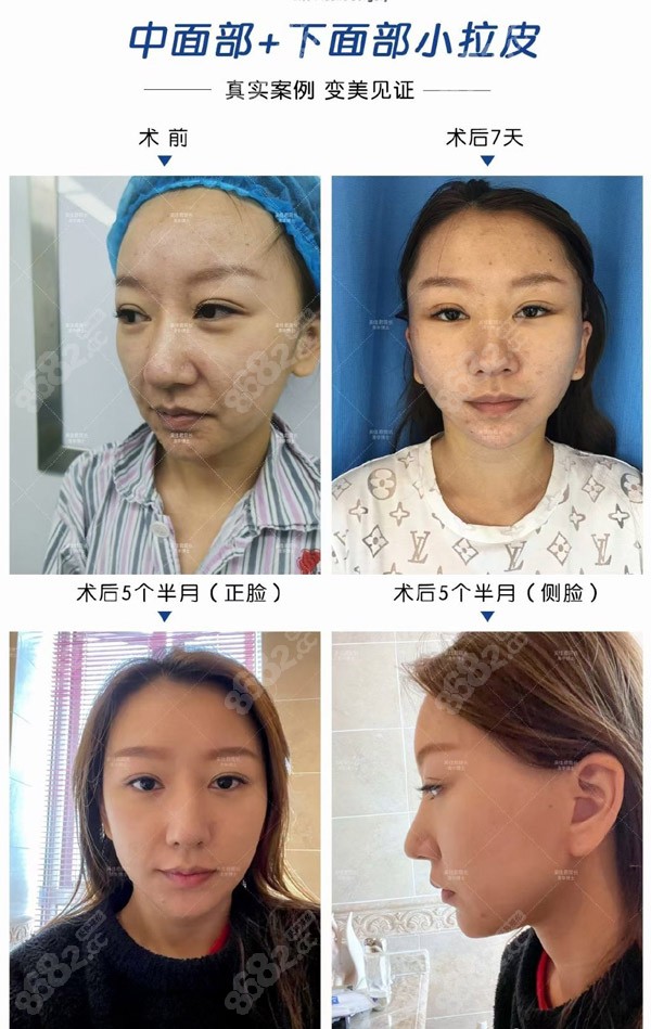 <!--<i data=20240705-sp></i>-->拉皮真实对比照