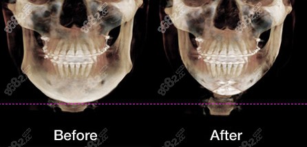 廣州廣大醫(yī)生磨骨手術(shù)前后CT圖片對(duì)比 廣州廣大醫(yī)生磨骨手術(shù)前后CT圖片對(duì)比