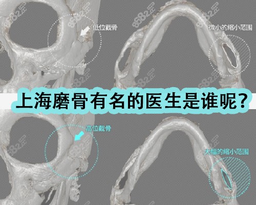 上海磨骨有名的医生是谁呢