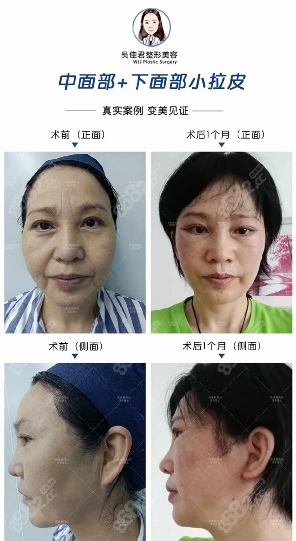 48岁拉皮术前术后一个月反馈对比