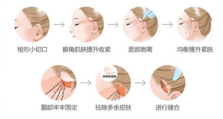 <!--<i data=20240705-sp></i>-->拉皮优势