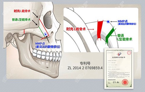 上海时光颧骨内推术