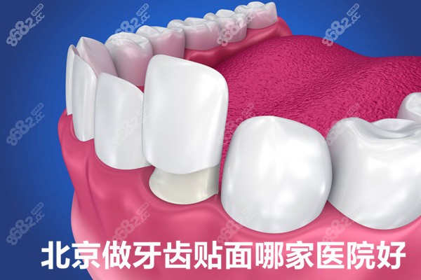 北京做贴面比较好的牙科名单 北京做贴面比较好的牙科名单