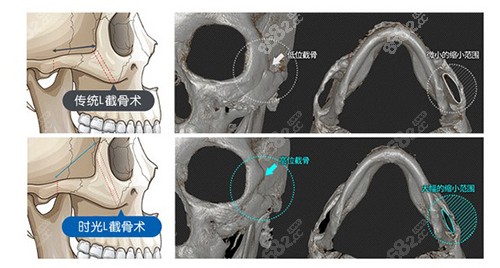 颧骨内推截图优势