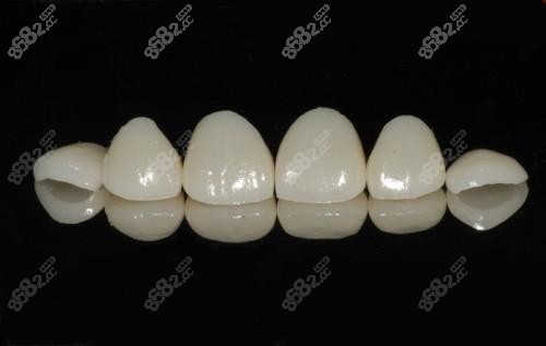 美观度较高的瓷贴面外观 美观度较高的瓷贴面外观