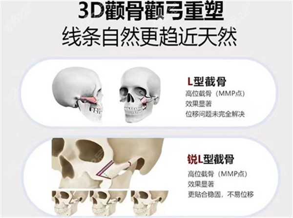 3D颧骨颧弓重塑