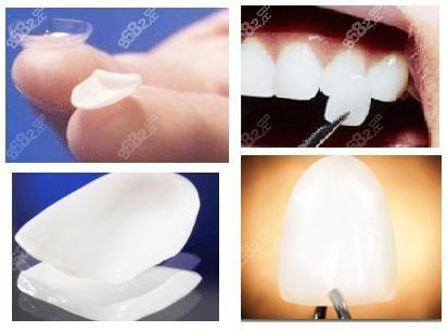 超薄瓷贴面的外观 超薄瓷贴面的外观