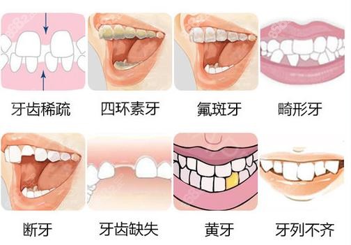 适合做修复的牙齿问题