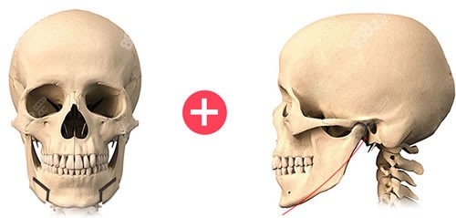 下颌角手术方式图