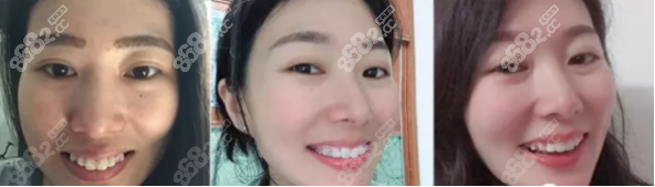 九江中山口腔醫(yī)院突嘴矯正真人效果圖 九江中山口腔醫(yī)院突嘴矯正真人效果圖