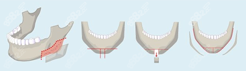 下颌角整形方式图