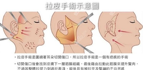 拉皮手术原理介绍