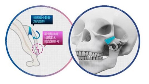 李志海三维颧骨缩小术原理