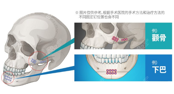 轮廓整形截骨固定方式图