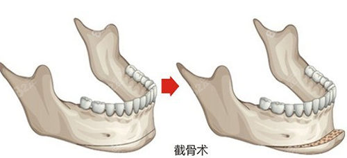 下颌角截骨术照片