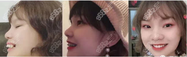九江中山口腔醫(yī)院牙齒矯正真人效果圖 九江中山口腔醫(yī)院牙齒矯正真人效果圖