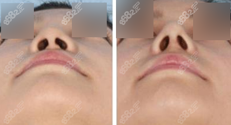 蒜头鼻整形手术前后对比图