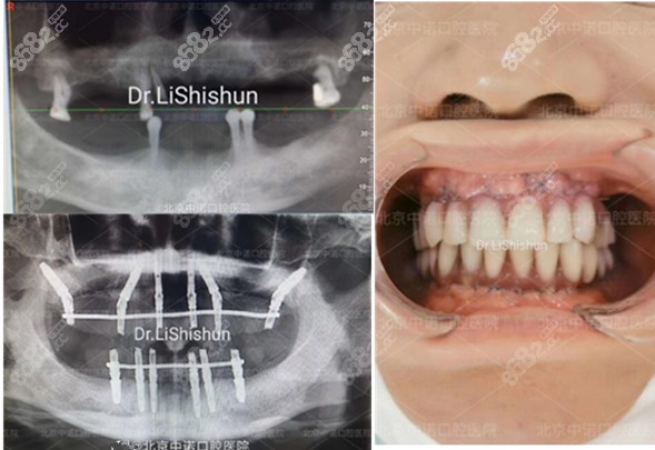 北京中诺口腔上颌穿翼板全口种植病例