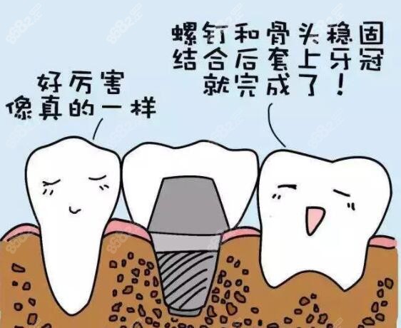 种植牙是人类的第三幅牙齿