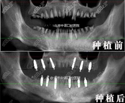 全口即刻种植病例 北京中诺