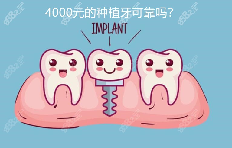 4000元的种植牙可靠吗