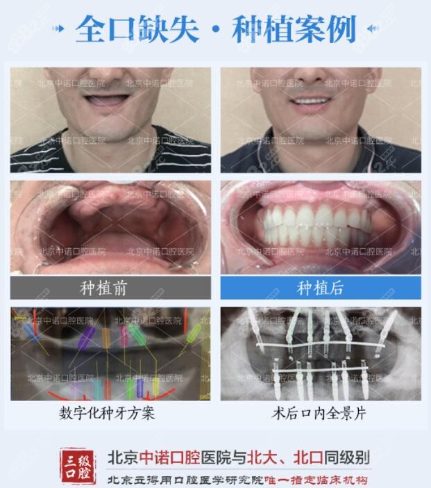 all on 6全口即刻负重种种植病例 北京中诺