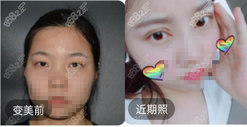 洛阳毛大夫医疗美容割双眼皮对比照