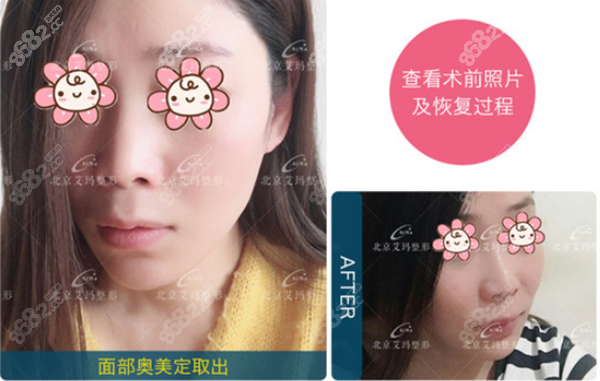 <!--<i data=20240705-sp></i>-->面部奥美定取出例子
