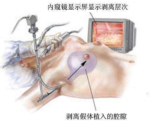 鲁天宇做胸怎么样