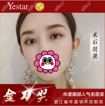 杭州艺星杨连华做双眼皮到底好不好？美杜莎眼综合术后效果参考