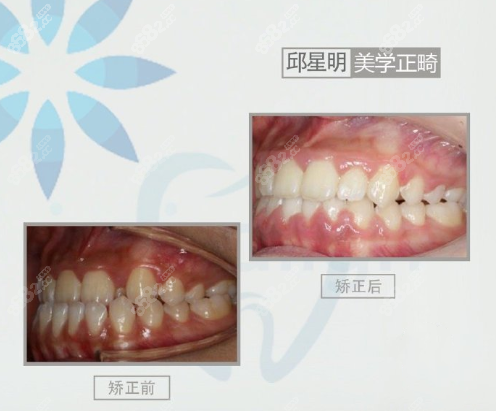 前牙后牙反颌（地包天）+中线不齐牙齿矫正效果