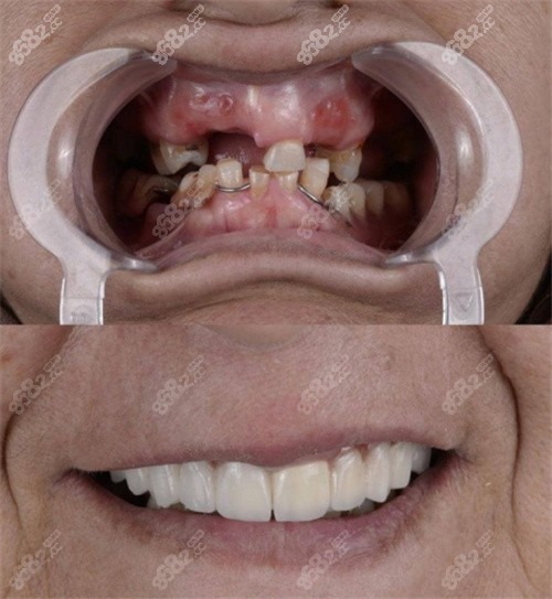 重庆团圆口腔种植牙技术