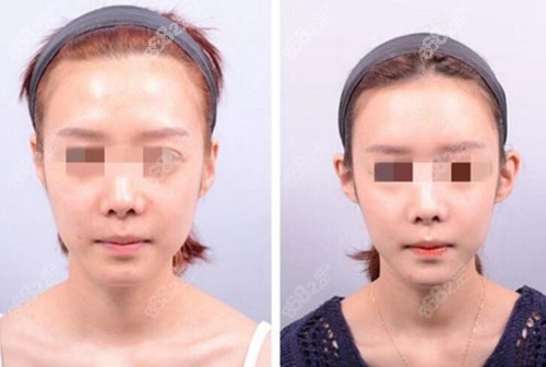 韩国普罗菲耳整形医院贴发耳矫正术前术后对比