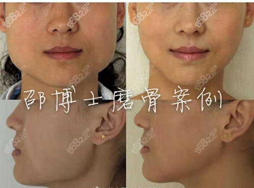 磨骨手术下颚有硬块_下颚磨骨手术_磨骨手术下颚角多少钱