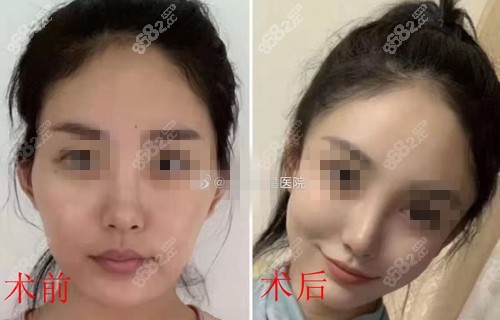 北京艺星医疗美容医院自体脂肪面部填充术前术后对比图