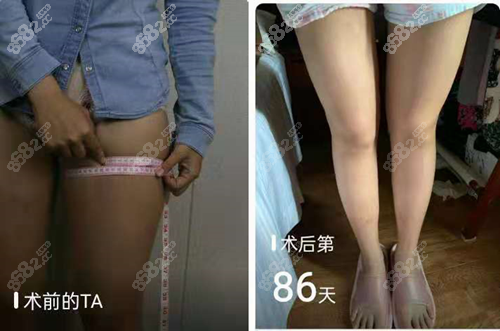 四川友谊医院吸脂对比照