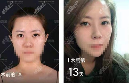 北京联合丽格闵英俊隆鼻术后13天的效果