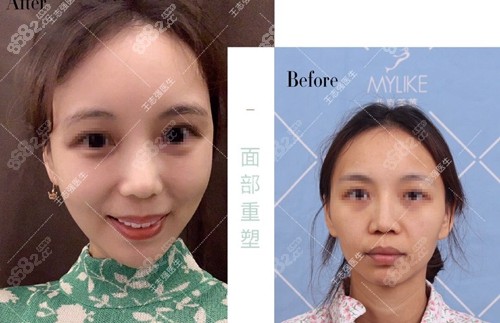 北京美莱医疗美容医院王志强医生自体脂肪填充面部术前术后对比图
