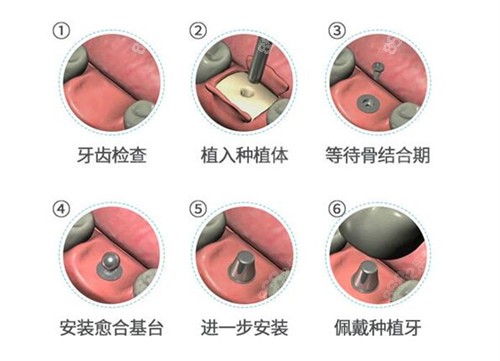 <!--<i data=20240705-sp></i>-->口腔种植牙流程